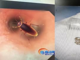 Man develops bad breath after cockroach crawls into his mouth, gets stuck in his throat when he was sleeping 